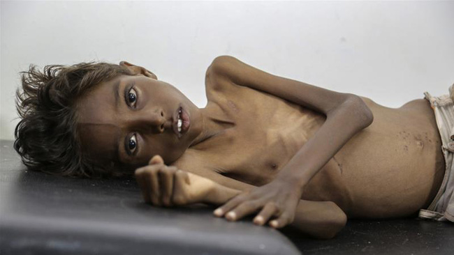 Bức hình bé trai 5 tuổi suy dinh dưỡng đầy ám ảnh về nỗi đau của trẻ em Yemen - Ảnh 1.