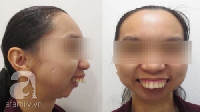 C&ocirc; g&aacute;i &ldquo;răng chuột&rdquo; qua 45 lần phẫu thuật, 30 năm kh&ocirc;ng thể ngủ nằm được cứu vớt cuộc đời - Ảnh 3.