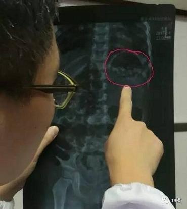 Nhầm hạt nhựa nở là kẹo, đôi vợ chồng Trung Quốc cho con gái 3 tuổi ăn hết gần... 300 viên - Ảnh 3. Nhầm hạt nhựa nở là kẹo, đôi vợ chồng Trung Quốc cho con gái 3 tuổi ăn hết gần... 300 viên - Ảnh 3.