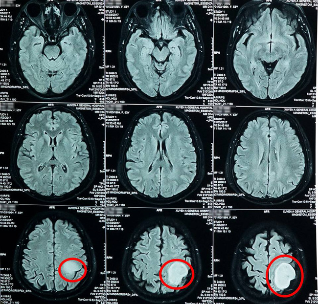 Nhức đầu thường xuyên, người phụ nữ đi khám thì phát hiện khối u não to bằng quả bóng tennis - Ảnh 4.