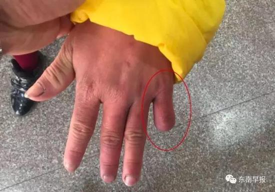 Bé gái 12 tuổi bị mẹ đẻ dùng kéo cắt ngón tay, châm thuốc lá đốt da - Ảnh 1. Bé gái 12 tuổi bị mẹ đẻ dùng kéo cắt ngón tay, châm thuốc lá đốt da - Ảnh 1.