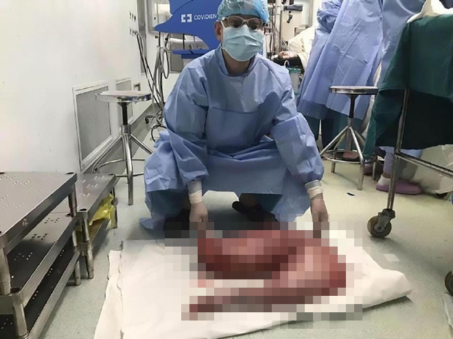 Ngỡ là bị táo bón thông thường, bác sĩ tá hỏa khi phát hiện đại tràng dài 76cm trong bụng bệnh nhân - Ảnh 2.