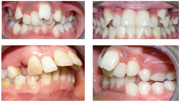 Chuyên gia cảnh báo: Đừng đợi quá muộn mới đi niềng răng - Ảnh 1.