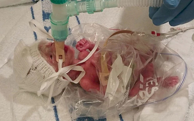 Em bé sinh non được bác sĩ cứu sống bằng một chiếc túi đựng bánh sandwich - Ảnh 1.