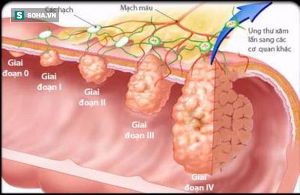 Ngày càng nhiều người trẻ mắc ung thư đại tràng: Chuyên gia chỉ dấu hiệu chắc chắn cần khám - Ảnh 1.