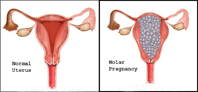Mang thai 3 tháng trong bụng, đi siêu âm mới thấy mình đang mang “chùm nho”, sự thật khiến cả nhà ngã ngửa... - Ảnh 4.