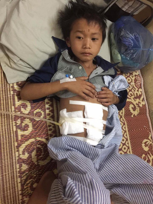 Cậu bé 10 tuổi bị trâu húc vỡ ruột non ở Yên Bái - Ảnh 1.