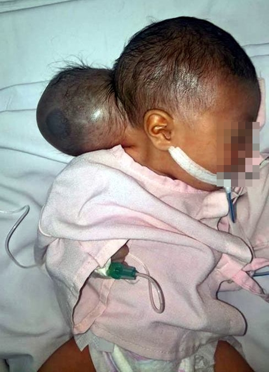 Bé gái mang khối u quái dị trông như có 2 đầu bị mẹ bỏ rơi khi đưa đến bệnh viện một ngày - Ảnh 4.