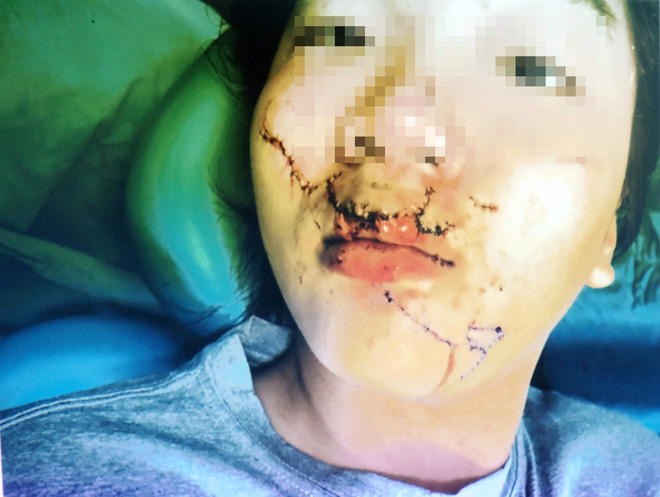 Ngã vào kính trường học trong ngày hành kinh, bé gái 11 tuổi bị huỷ hoại khuôn mặt nặng nề - Ảnh 4.