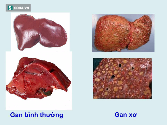  Mắt mía + nước dừa chữa bệnh xơ gan cổ trướng: Bài thuốc vô căn cứ! - Ảnh 1.