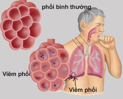 Loại nước tốt cho người viêm phổi - Ảnh 1.