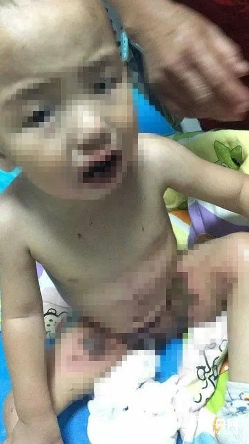 Tưởng nhầm chất tẩy là đường trắng, bé trai lấy ăn và nhập viện trong tình trạng nguy kịch - Ảnh 1. Tưởng nhầm chất tẩy là đường trắng, bé trai lấy ăn và nhập viện trong tình trạng nguy kịch - Ảnh 1.