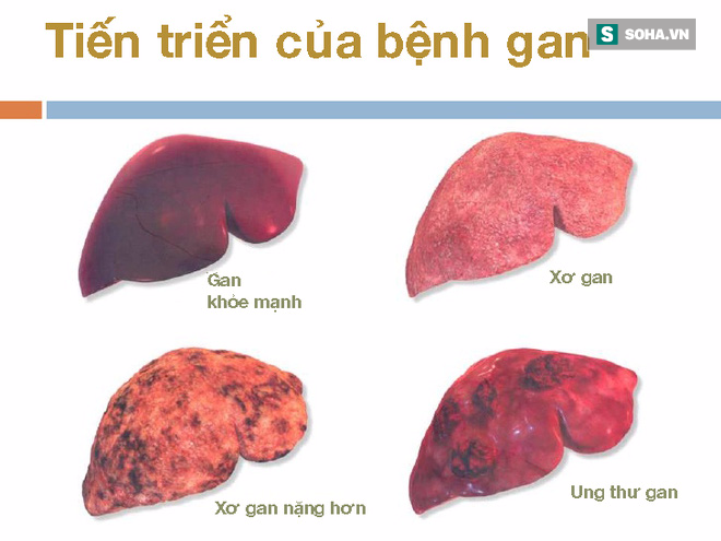 Dấu hiệu quan trọng cảnh báo bệnh gan đang tiến triển trong cơ thể, nếu có thì hãy đi khám - Ảnh 2.