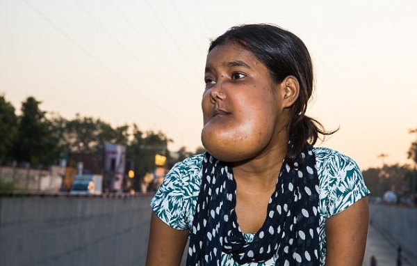 Ấn Độ: Căn bệnh quái ác khiến thiếu nữ mang khuôn mặt của quỷ dữ và bị cả xã hội ruồng bỏ - Ảnh 2.
