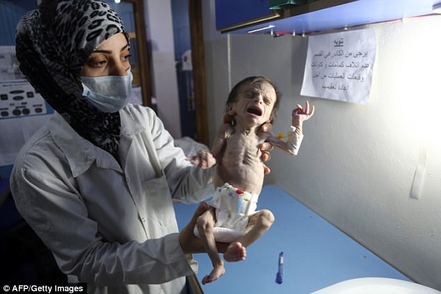 Em bé Syria với thân hình chỉ còn da bọc xương giữa bom đạn chiến tranh khiến cả thế giới xót xa - Ảnh 2.