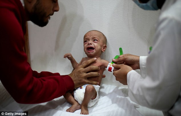 Em bé Syria với thân hình chỉ còn da bọc xương giữa bom đạn chiến tranh khiến cả thế giới xót xa - Ảnh 6.