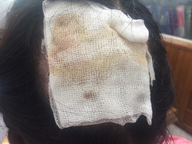 Tai nạn nghiêm khi uốn tóc: Tóc cuốn vào ống dẫn nhiệt, nữ bác sĩ bỏng sâu, tróc gần toàn bộ da đầu phía sau - Ảnh 2.