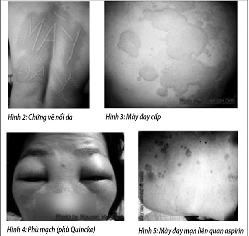 Một số bệnh tấn công da mùa hanh khô - Ảnh 1.