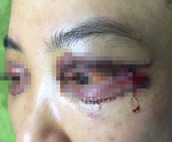 Là tiểu phẫu nhưng cắt mí hay bóc mỡ bọng mắt cũng có thể gây ra những hậu quả nhìn kinh khủng như thế này - Ảnh 9.