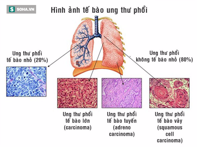 4 nhóm nghề nghiệp có nguy cơ mắc ung thư phổi cao nhất, hãy cảnh giác để phòng tránh sớm - Ảnh 1.