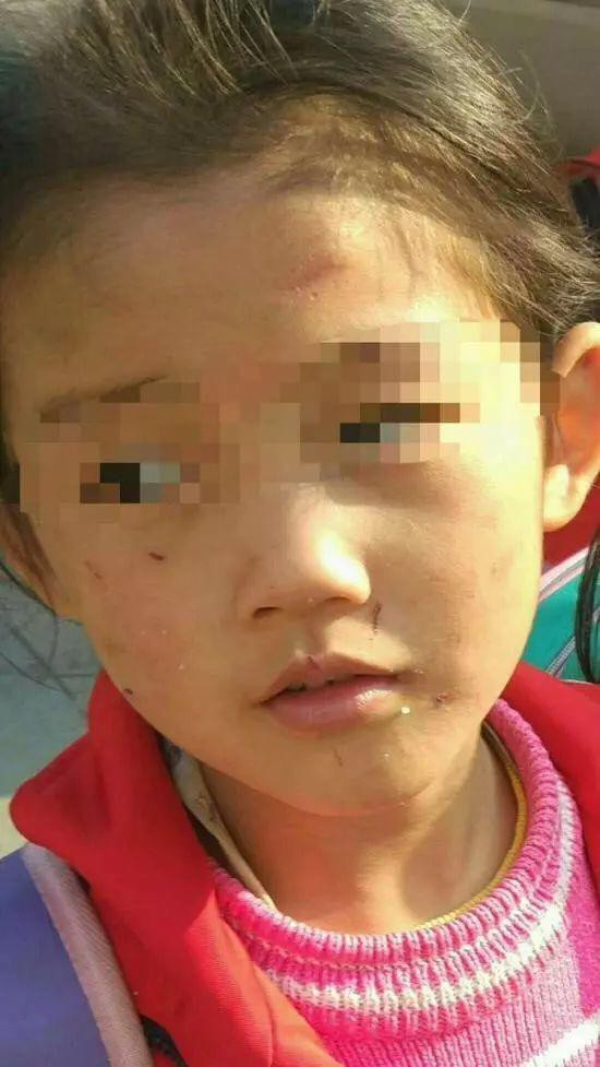 Bé gái 6 tuổi bị mẹ đẻ ngược đãi dã man khiến mặt đầy vết thương, tóc rụng thành mảng lớn - Ảnh 1. Bé gái 6 tuổi bị mẹ đẻ ngược đãi dã man khiến mặt đầy vết thương, tóc rụng thành mảng lớn - Ảnh 1.