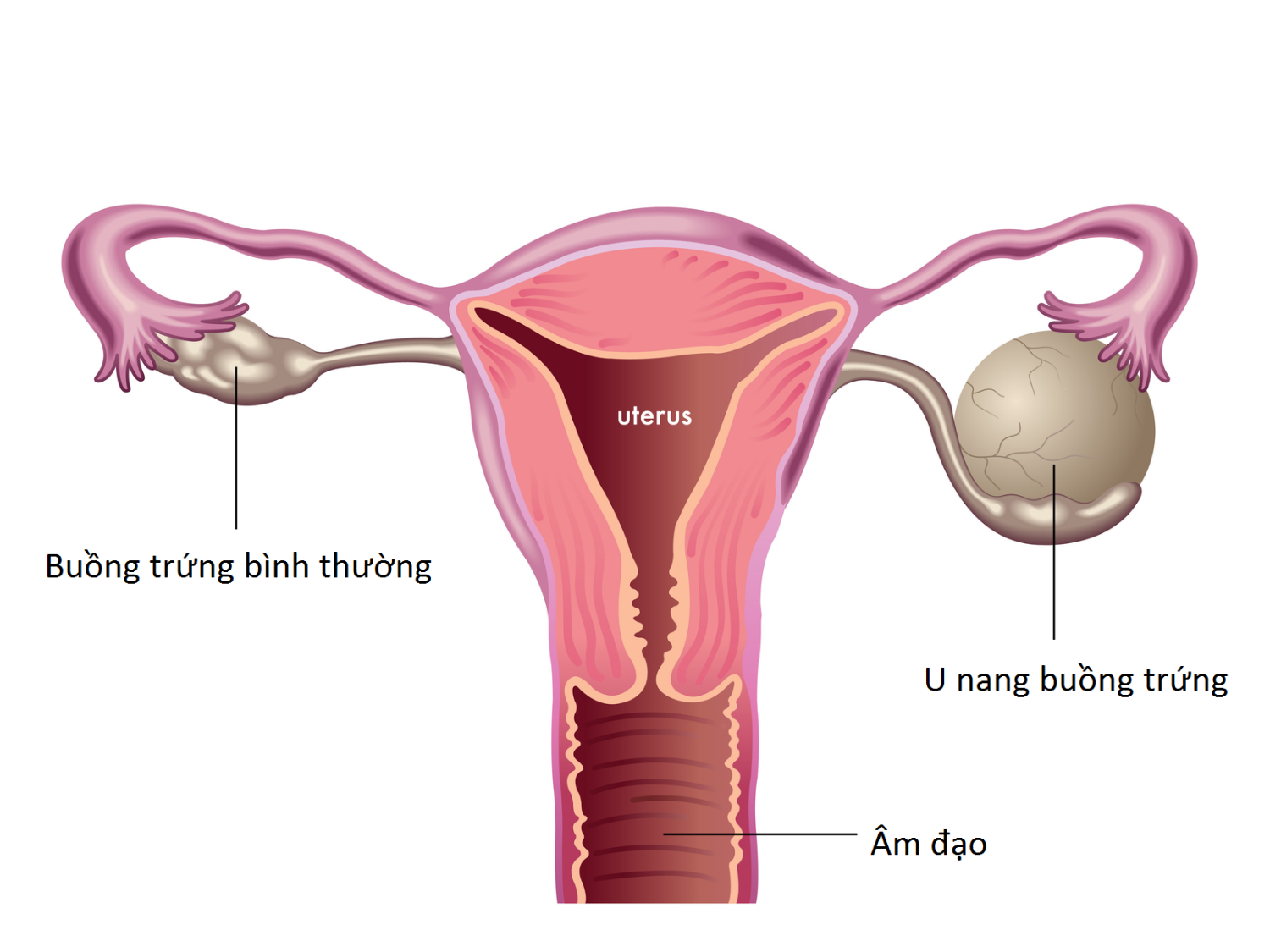 Con gái cần lưu ý: Bị chuột rút thường xuyên có thể là dấu hiệu của 5 bệnh phụ khoa nguy hiểm sau - Ảnh 2.