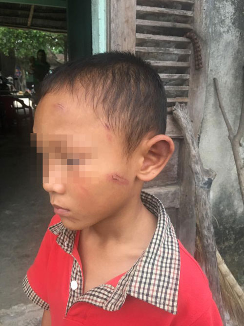 Bé trai 5 tuổi bị dì ruột bạo hành dã man - Ảnh 1.