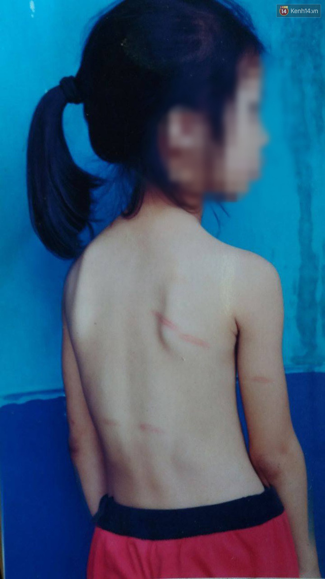 Nghệ An: Học sinh lớp 1 bị cô giáo đánh thâm tím lưng và chân vì không làm được bài - Ảnh 3.