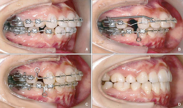 Chuyên gia cảnh báo: Đừng đợi quá muộn mới đi niềng răng - Ảnh 4.