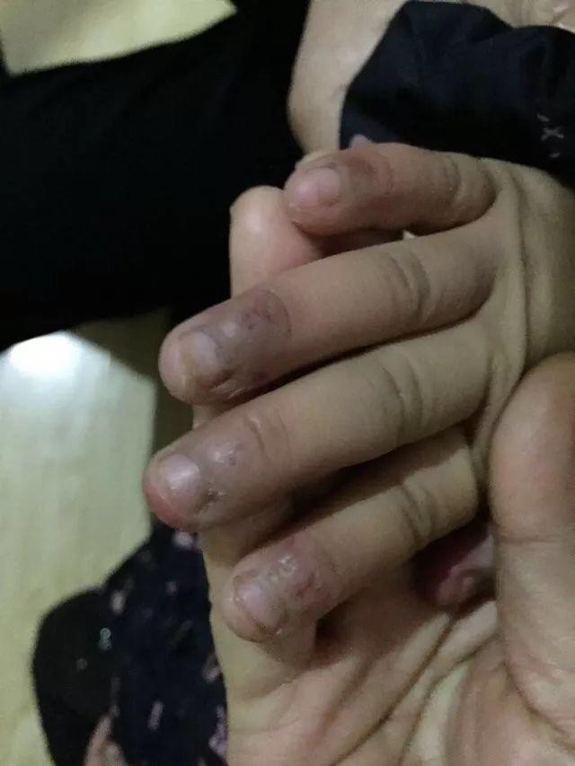 Bé gái 6 tuổi bị mẹ đẻ ngược đãi dã man khiến mặt đầy vết thương, tóc rụng thành mảng lớn - Ảnh 4. Bé gái 6 tuổi bị mẹ đẻ ngược đãi dã man khiến mặt đầy vết thương, tóc rụng thành mảng lớn - Ảnh 4.
