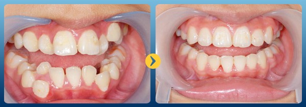 Chuy&ecirc;n gia cảnh b&aacute;o: Đừng đợi qu&aacute; muộn mới đi niềng răng - Ảnh 5.