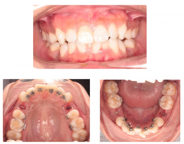 Chuy&ecirc;n gia cảnh b&aacute;o: Đừng đợi qu&aacute; muộn mới đi niềng răng - Ảnh 6.