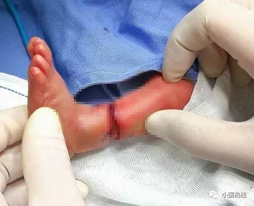 Bị dải sợi ối quấn, em bé suýt phải cưa chân khi vừa chào đời