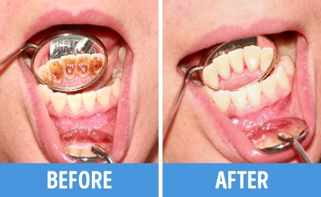 Nếu bạn phạm phải 6 thói quen này khi đánh răng, nhai thức ăn thì cần phải loại bỏ ngay còn kịp - Ảnh 6.