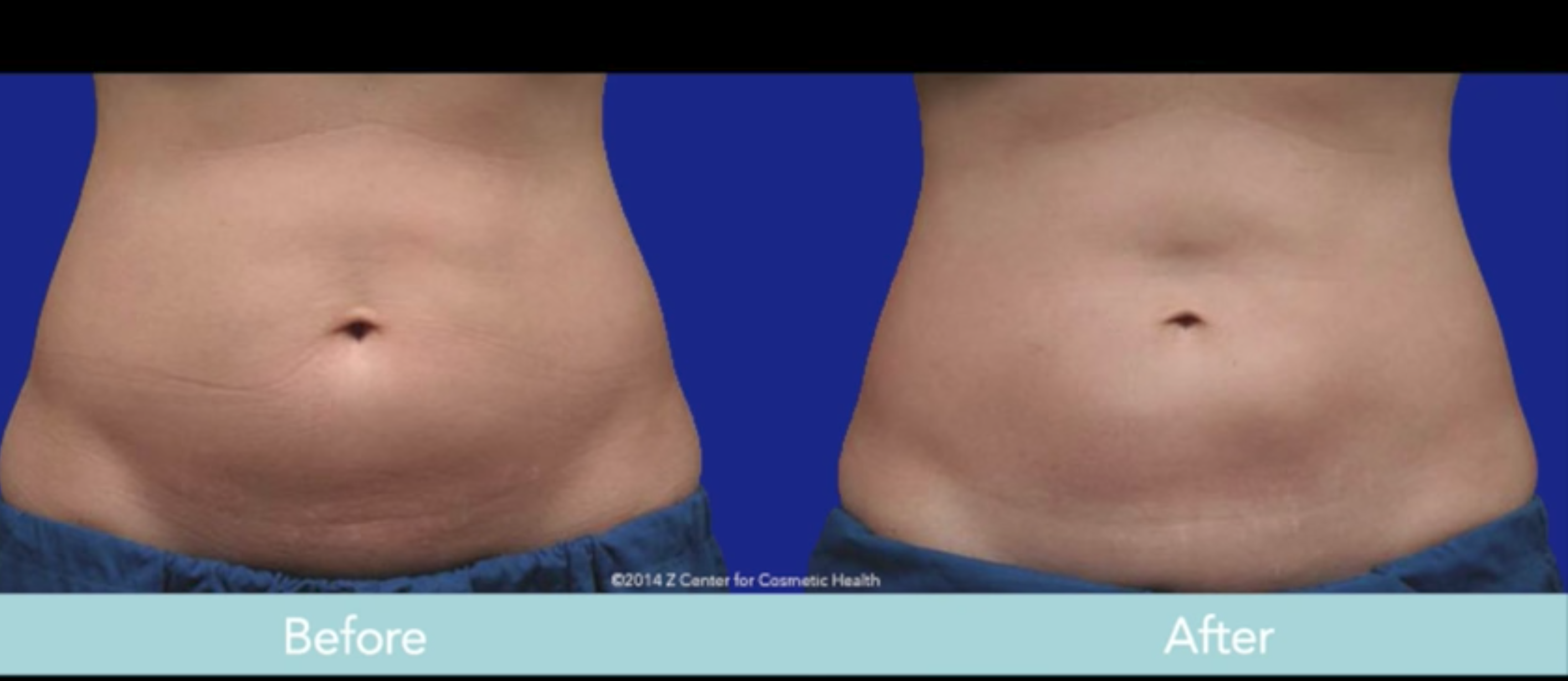 Hai phương ph&aacute;p giảm c&acirc;n Slimming Body đang hot nhất hiện nay - Ảnh 8.