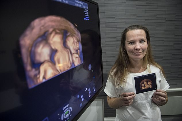 Khao khát có thêm con, mẹ khá sốc nghe bác sĩ bảo phải sinh sớm 10 tuần chỉ vì thai kì quá hiếm - Ảnh 2.