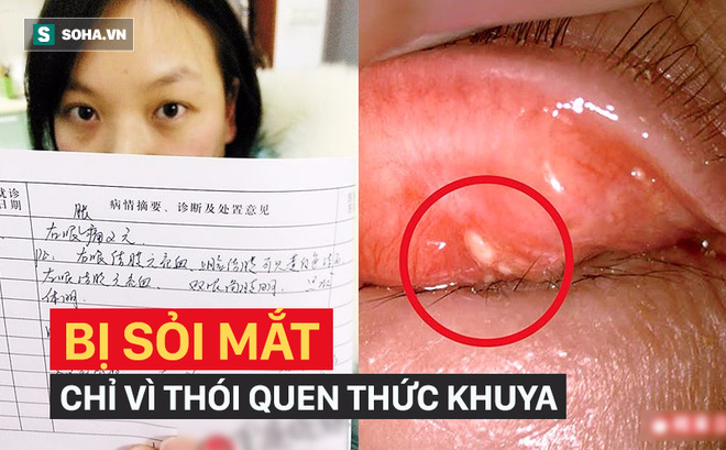 Co Gai Bị Sỏi Mắt Mọc Chi Chit Phải Nhập Viện Cấp Cứu Chỉ Vi Thoi