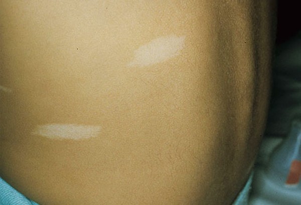 Xuất hiện những chấm trắng trên da như này, đừng chủ quan vì có thể là dấu hiệu của bệnh nguy hiểm - Ảnh 2.