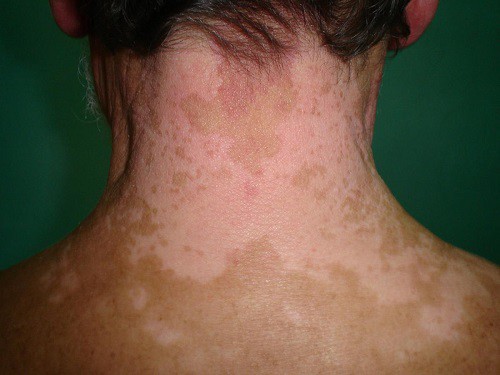 Xuất hiện những chấm trắng trên da như này, đừng chủ quan vì có thể là dấu hiệu của bệnh nguy hiểm - Ảnh 6.