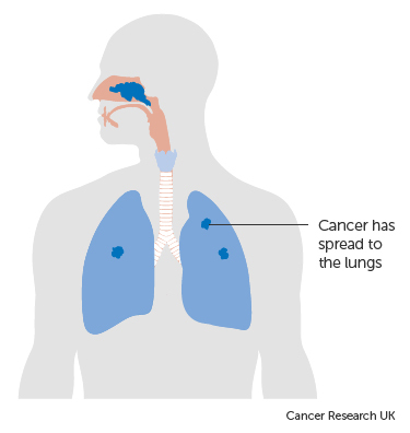 3 yếu tố làm tăng nguy cơ bị ung thư vòm họng mà rất nhiều người bỏ qua - Ảnh 5.