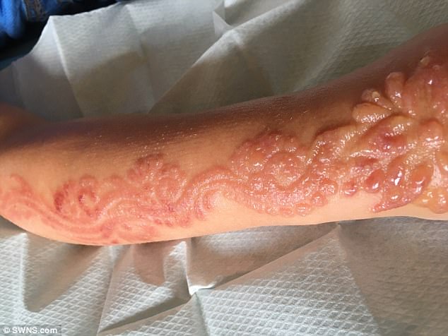 Được bố thưởng cho vẽ henna lên tay, bé gái 7 tuổi đã phải khóc đau đớn khi cánh tay bỏng rộp đáng sợ - Ảnh 3.