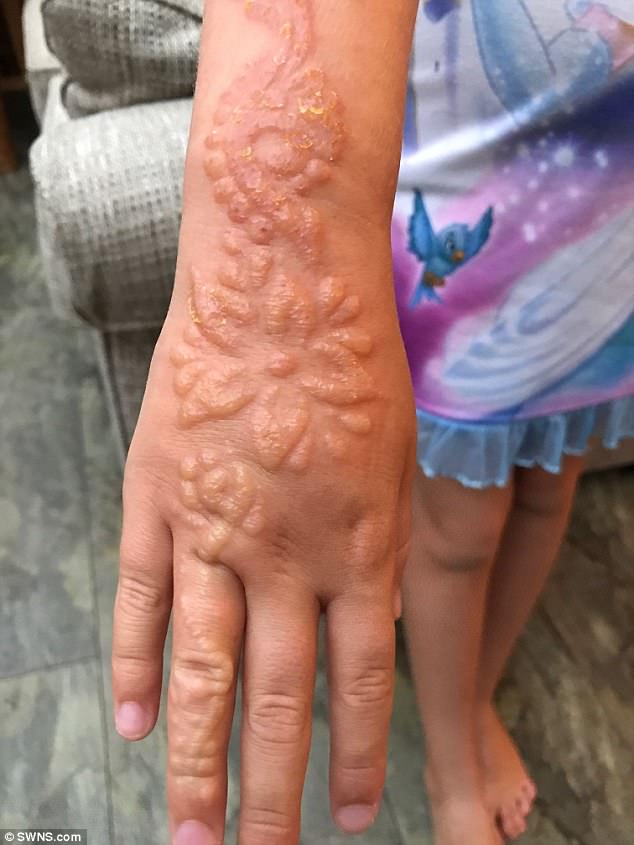 Được bố thưởng cho vẽ henna lên tay, bé gái 7 tuổi đã phải khóc đau đớn khi cánh tay bỏng rộp đáng sợ - Ảnh 7.