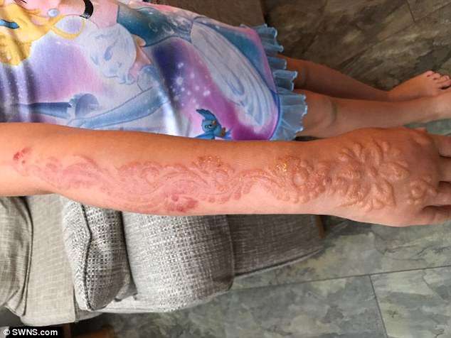 Được bố thưởng cho vẽ henna lên tay, bé gái 7 tuổi đã phải khóc đau đớn khi cánh tay bỏng rộp đáng sợ - Ảnh 6.