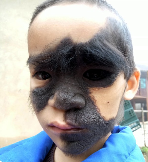 Vụ bé trai bị u sắc tố bẩm sinh có khuôn mặt như người rừng: Đã có nhà hảo tâm nhận đưa bé đi trị bệnh - Ảnh 3.
