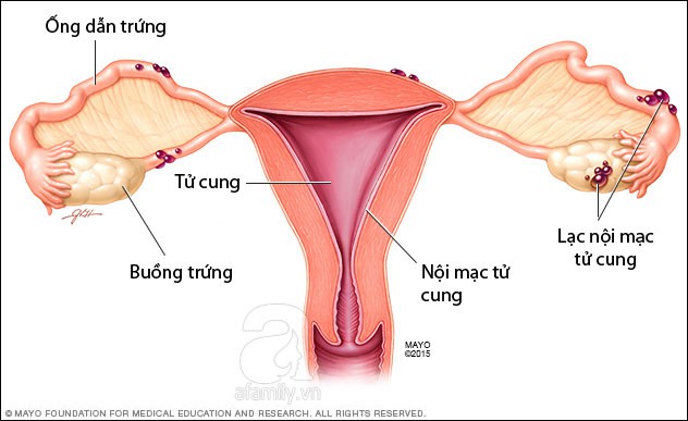 Dấu hiệu cảnh báo bạn đang bị cả hội chứng buồng trứng đa nang và lạc nội mạc tử cung khiến việc có thai càng mù mịt - Ảnh 5.