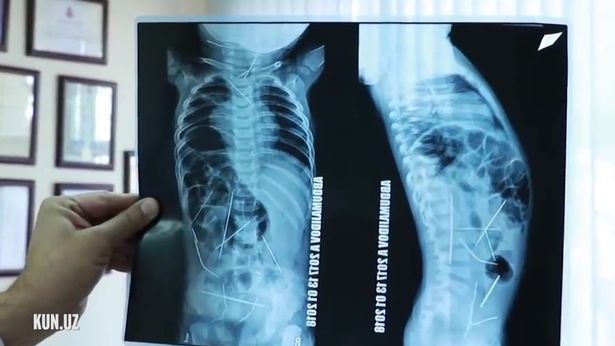 Con sốt cao, tiểu tiện khó khăn, mẹ đưa đến bệnh viện và ngã quỵ khi nhìn thấy hình chụp X-quang - Ảnh 3.