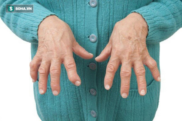 Viêm khớp dạng thấp rất khó chữa: 9 liệu pháp tự nhiên hiệu quả nhất bạn nên tham khảo - Ảnh 1. Viêm khớp dạng thấp rất khó chữa: 9 liệu pháp tự nhiên hiệu quả nhất bạn nên tham khảo - Ảnh 1.