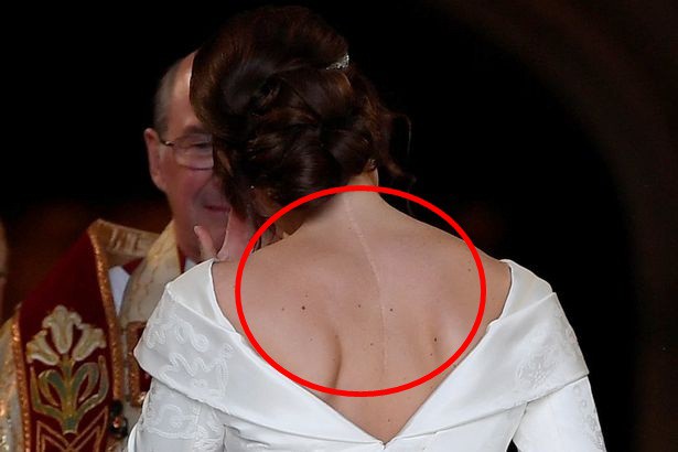 Điều ít biết đằng sau vết sẹo dài xấu xí dọc sống lưng mà Công chúa Eugenie cố tình khoe trọn trong chiếc váy cưới - Ảnh 2.