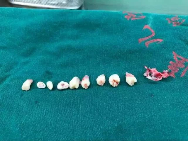 Cậu bé 5 tuổi bị đau đầu, nôn mửa, đi khám bác sĩ phát hiện có tới 9 chiếc răng trong não - Ảnh 2.