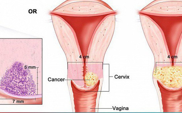 Phụ nữ càng lớn tuổi càng đối mặt với nguy cơ ung thư cao - Ảnh 1.